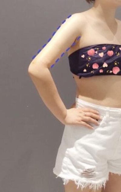 蚌埠市第三人民醫(yī)院燒傷整形科楊蔚做手臂吸脂效果對(duì)比圖 蚌埠市第三人民醫(yī)院燒傷整形科楊蔚做手臂吸脂效果對(duì)比圖