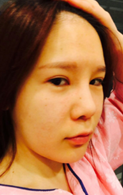 安康希顏醫(yī)療整形醫(yī)生王奇效做面部吸脂怎么樣？附案例效果對比圖