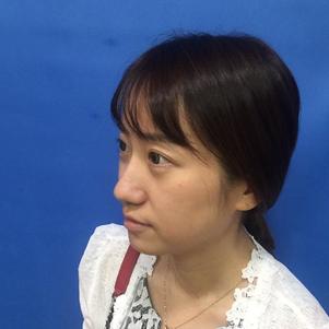 蚌埠韓美美萊整形做玻尿酸面部除皺效果怎么樣？附陳澤醫(yī)生案例效果圖