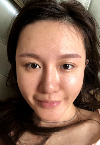 蚌埠韓美美萊整形醫(yī)生張燕做自體脂肪豐面頰效果怎么樣？附案例效果圖