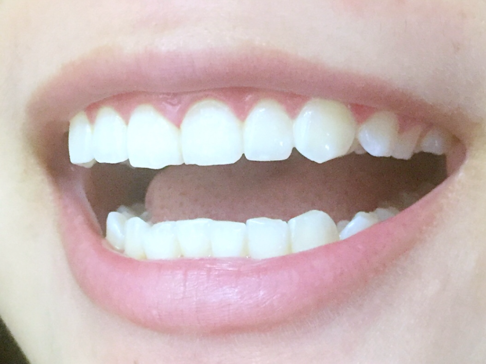 安慶渡江口腔醫(yī)院張良斌醫(yī)生做超聲波洗牙效果怎么樣？附洗牙案例效果圖