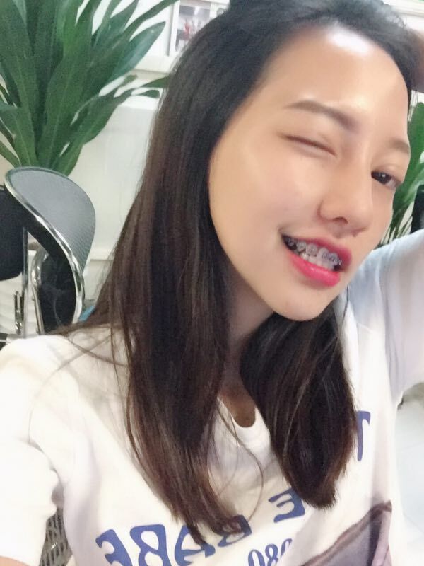 巴中華醫(yī)口腔醫(yī)院做牙齒矯正效果好嗎？附母汶靈醫(yī)生牙齒矯正案例效果圖