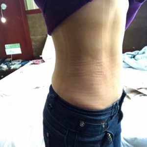 蚌埠韓美美萊整形醫(yī)生張濤做水動(dòng)力吸脂怎么樣？附吸脂案例效果圖