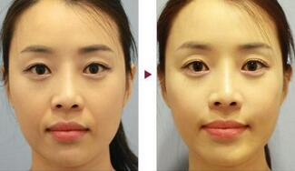 保定安卓貝拉做注射去法令紋怎么樣？附儲君醫(yī)生法令紋案例效果圖