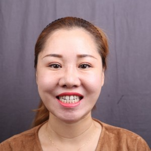 保定東陽口腔醫(yī)院趙晨醫(yī)生做瓷貼面怎么樣？附瓷貼面案例效果對比圖