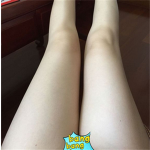 保定市第五醫(yī)院美容整形科做大腿吸脂怎么樣？附劉根立醫(yī)生案例效果圖