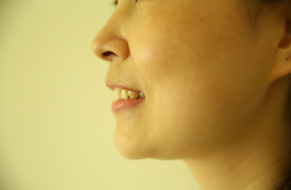 保定東陽(yáng)口腔醫(yī)院趙星醫(yī)生做牙齒瓷貼面怎么樣?附牙齒瓷貼面案例效果對(duì)比圖 保定東陽(yáng)口腔醫(yī)院趙星醫(yī)生做牙齒瓷貼面怎么樣?附牙齒瓷貼面案例效果對(duì)比圖