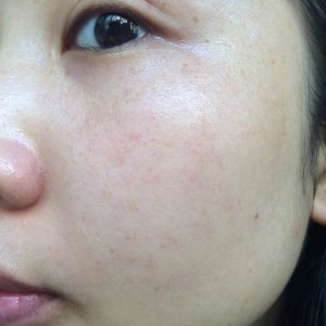 寶雞皮膚病醫(yī)院文東亮醫(yī)生做臉部祛斑效果怎么樣？附臉部祛斑案例