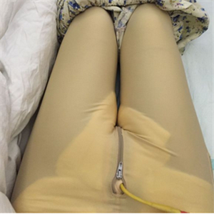 保定市第五醫(yī)院美容整形科做大腿吸脂怎么樣？附劉根立醫(yī)生案例效果圖