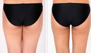 蚌埠市第三人民醫(yī)院燒傷整形科徐衛(wèi)東醫(yī)生做臀部吸脂效果怎么樣？