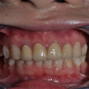 保定東陽口腔醫(yī)院張亞靜醫(yī)生做牙齒冷光美白怎么樣？附冷光美白案例效果對比圖