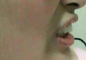 保定東陽口腔醫(yī)院馮春城醫(yī)生做烤瓷牙怎么樣？附烤瓷牙案例效果對比圖