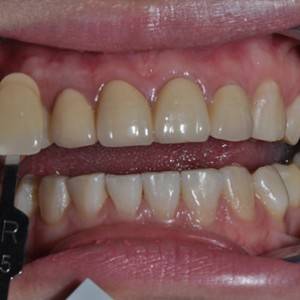 保定東陽口腔醫(yī)院張亞靜醫(yī)生做牙齒冷光美白怎么樣？附冷光美白案例效果對比圖