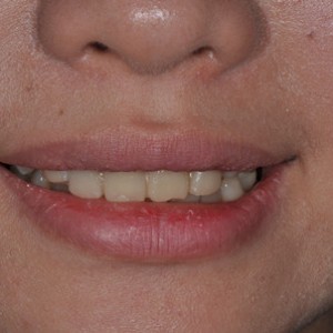 保定東陽口腔醫(yī)院張亞靜醫(yī)生做牙齒冷光美白怎么樣？附冷光美白案例效果對比圖