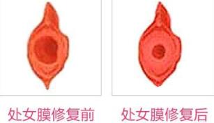 蚌埠市第三人民醫(yī)院燒傷整形科許瑾醫(yī)生做處女摸修復(fù)怎么樣？附案例