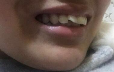 保定東陽口腔醫(yī)院馮春城醫(yī)生做烤瓷牙怎么樣？附烤瓷牙案例效果對比圖