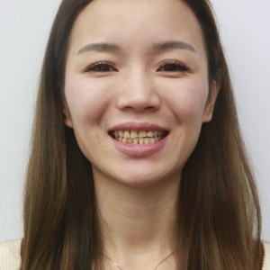 保定東陽口腔醫(yī)院興磊醫(yī)生做牙齒貼面怎么樣？附牙齒貼面案例效果對(duì)比圖