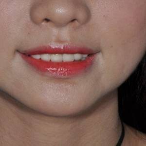 保定東陽口腔醫(yī)院張亞靜醫(yī)生做牙齒冷光美白怎么樣？附冷光美白案例效果對比圖