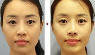 保定安卓貝拉做注射去法令紋怎么樣？附儲君醫(yī)生法令紋案例效果圖