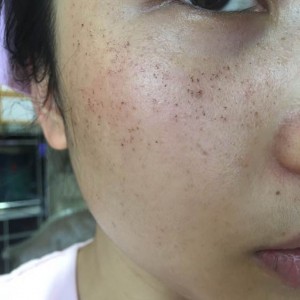 寶雞皮膚病醫(yī)院文東亮醫(yī)生做臉部祛斑效果怎么樣？附臉部祛斑案例