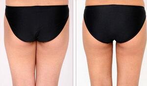 蚌埠市第三人民醫(yī)院燒傷整形科徐衛(wèi)東醫(yī)生做臀部吸脂效果怎么樣？