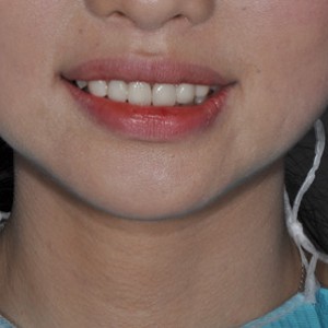 保定東陽口腔醫(yī)院張亞靜醫(yī)生做牙齒冷光美白怎么樣？附冷光美白案例效果對比圖