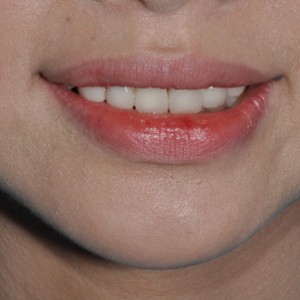 保定東陽口腔醫(yī)院張亞靜醫(yī)生做牙齒冷光美白怎么樣？附冷光美白案例效果對比圖