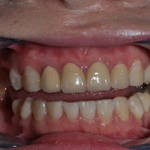 保定東陽口腔醫(yī)院張亞靜醫(yī)生做牙齒冷光美白怎么樣？附冷光美白案例效果對比圖