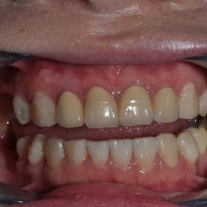 保定東陽口腔醫(yī)院張亞靜醫(yī)生做牙齒冷光美白怎么樣？附冷光美白案例效果對比圖