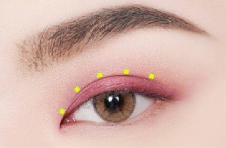 廈門華美名媛整形美容醫(yī)院雙眼皮