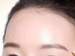 貴陽利美康醫(yī)院自體脂肪豐額頭