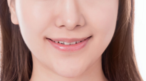 駝峰鼻矯正費(fèi)用怎么樣？駝峰鼻矯正恢復(fù)期多久？