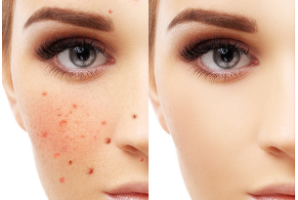 激光祛斑的一般價格是多少？