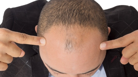 頭發(fā)可以種植嗎？頭發(fā)種植一般需要多少錢？