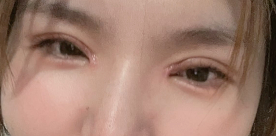 全切雙眼皮好看嗎？做全切雙眼皮手術(shù)需要多長時(shí)間？