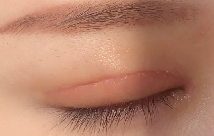 全切雙眼皮多久恢復(fù)？全切開雙眼皮有哪些優(yōu)點(diǎn)？