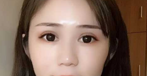 全切雙眼皮會(huì)越來(lái)越窄嗎？全切雙眼皮消腫的辦法有哪些？