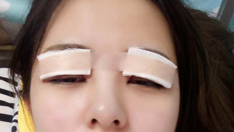 全切雙眼皮怎么恢復(fù)快？