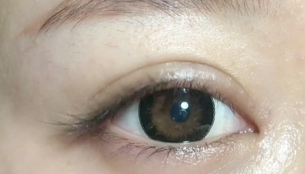 全切雙眼皮失敗可以修復(fù)嗎？