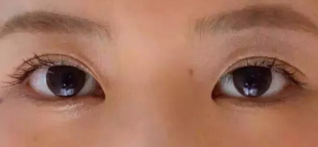 全切雙眼皮術(shù)后會疼幾天？