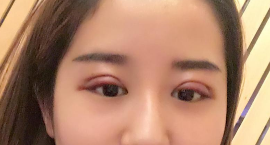 全切雙眼皮好不好？