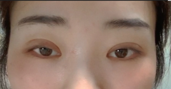 什么是全切雙眼皮？全切雙眼皮的恢復(fù)時間？