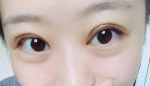 全切雙眼皮術后會反彈嗎？