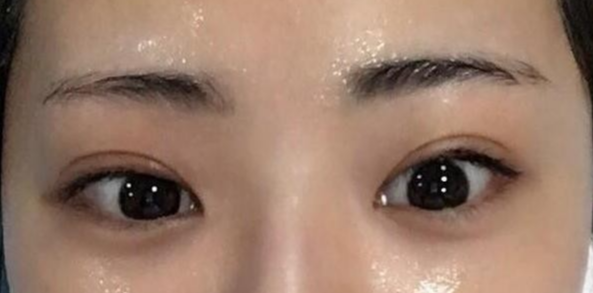 雙眼皮全切的風(fēng)險(xiǎn)有哪些？