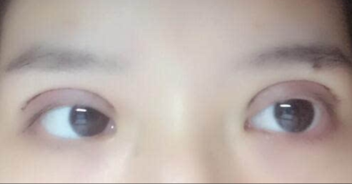 全切雙眼皮手術(shù)優(yōu)勢(shì)？雙眼皮全切的風(fēng)險(xiǎn)有哪些？