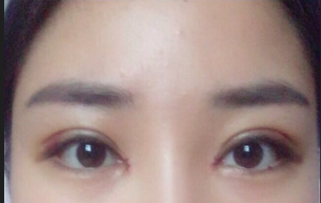 雙眼皮全切術(shù)后注意事項有哪些？