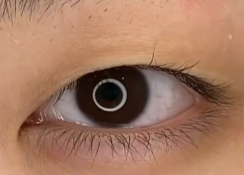 全切雙眼皮幾天可以洗臉？