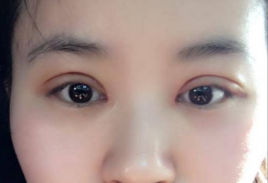 做全切雙眼皮多少錢？