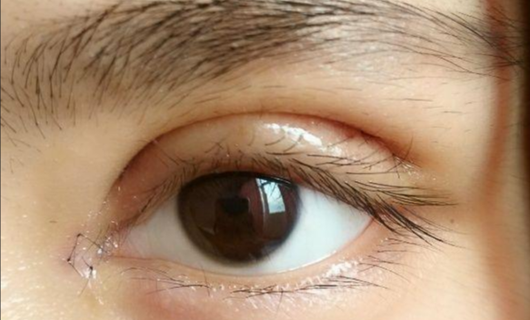 全切雙眼皮會留疤嗎？全切雙眼皮的優(yōu)缺點？