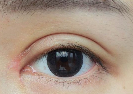 什么是雙眼皮全切？全切雙眼皮拆線(xiàn)多久恢復(fù)？